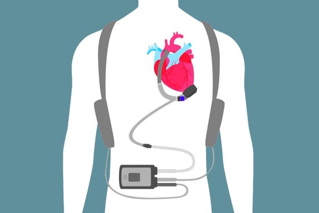 asistencia-ventricular